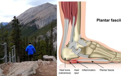 Hiking Injury – Plantar Fasciitis